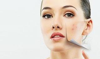 痘印怎么消除小妙招